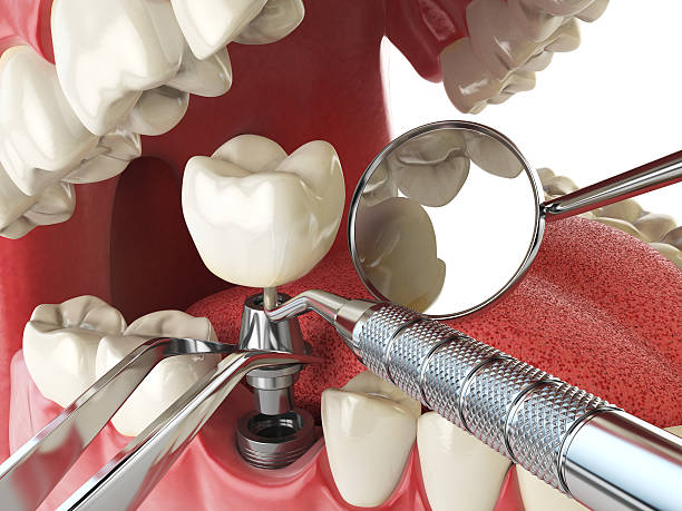 Best Emergency Dentist for Lost Fillings or Crowns in Beechwood Trails, OH